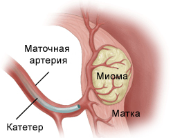 Эмболизация маточных артерий (ЭМА)