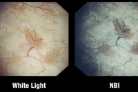 Узкоспектральная визуализация (NBI) при проведении эндоскопии 