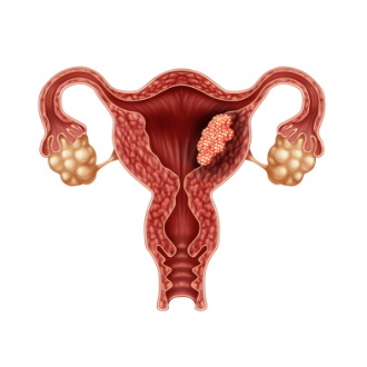 endometrium rák 1. stádium