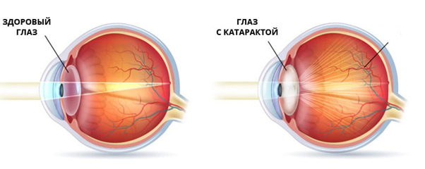 Ранняя хирургия хрусталика глаза