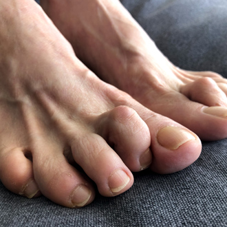 Молоткообразные пальцы стопы