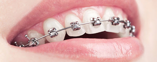 Ортодонтия: как исправить прикус зубов