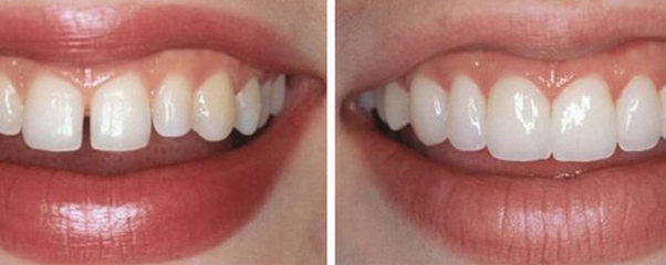 Керамические реставрации — новые возможности восстановления зубов