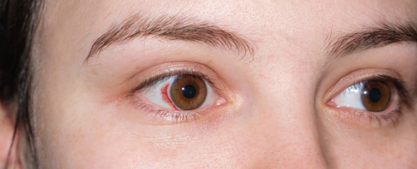 Непроникающие ранения глаза