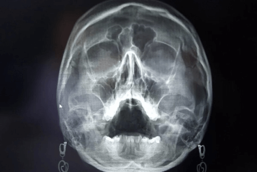 Рентген снимок носа
