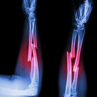 Переломы костей: причины, симптомы, виды и лечение | Название сайта