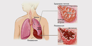 Патогенез внебольничной пневмонии у пожилых