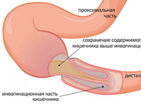 Neprohodimost Kishechnika Diagnostika I Lechenie V Sm Klinika Prichiny Simptomy Vidy Neprohodimosti Kishechnika