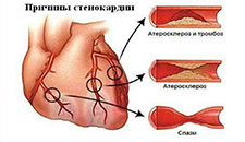 Симптомы и синдромы при стенокардии thumbnail