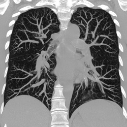 Мультиспиральная компьютерная томография органов грудной клетки
