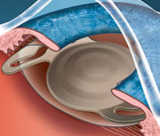 Факоэмульсификация при катаракте