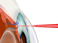 Лазерное лечение глаукомы 