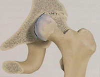 Асептический некроз головки бедренной кости (АНГБК)